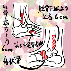 「Ottawa Ankle Rules ー足関節捻挫それとも骨折？ー」の画像